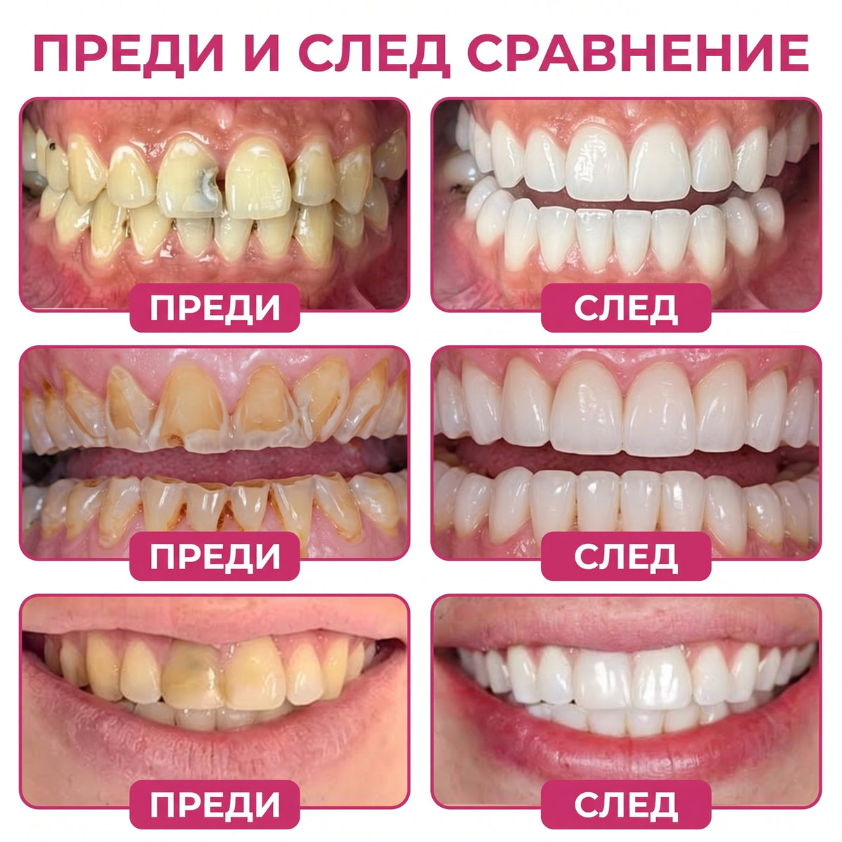 Keyess® DenPerm🎉🪶🪶 — Възстановяване при кариес Натурален гел за запьлване на зъбния емайл, Чувствителни зъби и отслабен емайл