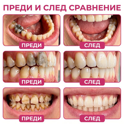 Keyess® DenPerm🎉🪶🪶 — Възстановяване при кариес Натурален гел за запьлване на зъбния емайл, Чувствителни зъби и отслабен емайл